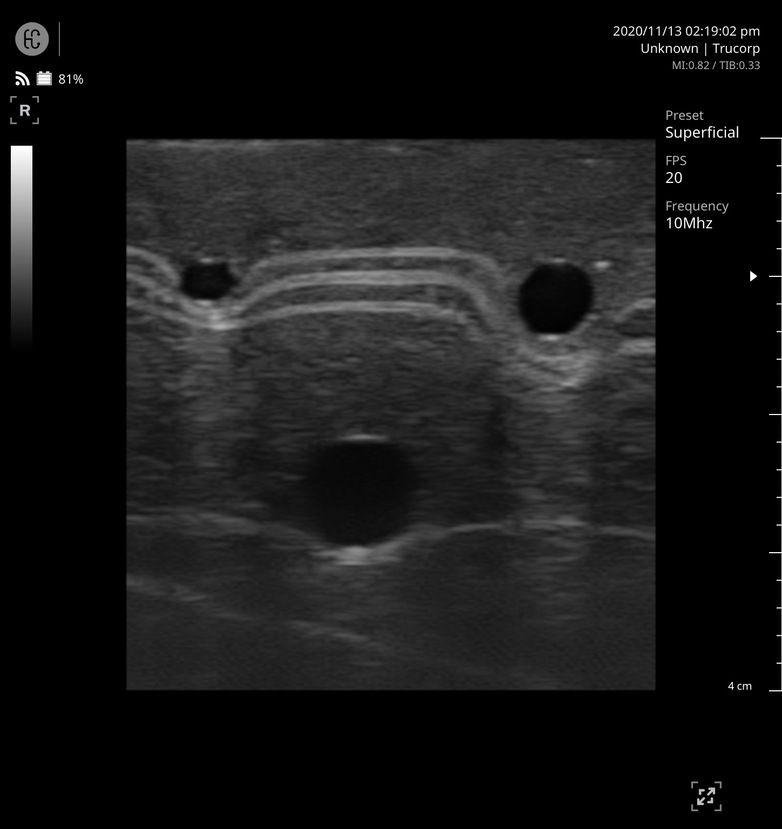 Internal Ultrasound Image (2)