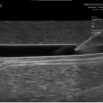 Longitudinal view of needle entering vein