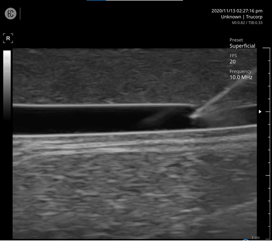 Longitudinal view of needle entering vein