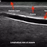 TruNerveBlock Ultrasound Image Longitudinal