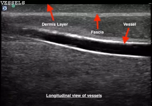 TruNerveBlock Ultrasound Image Longitudinal