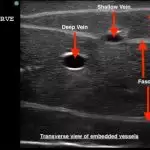 TruNerveBlock Ultrasound Image Transverse