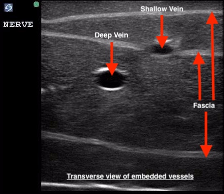 TruNerveBlock Ultrasound Image Transverse