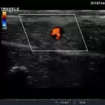 TruNerveBlock Ultrasound Image Colour Doppler