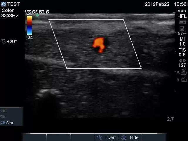 TruNerveBlock Ultrasound Image Colour Doppler