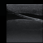 TCVC100 - TruCVC Ultrasound Imagining (1)