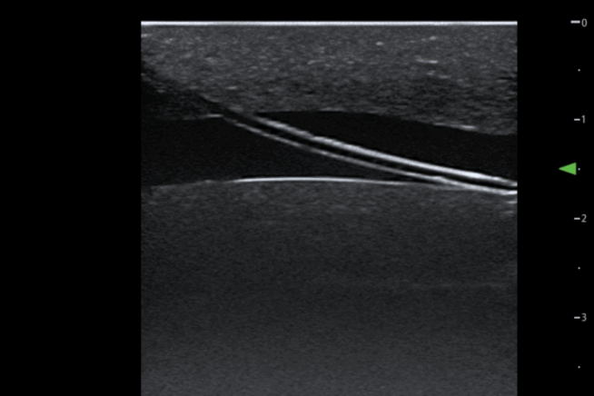 TCVC100 - TruCVC Ultrasound Imagining (1) TruCVC Ultrasound Imaging
