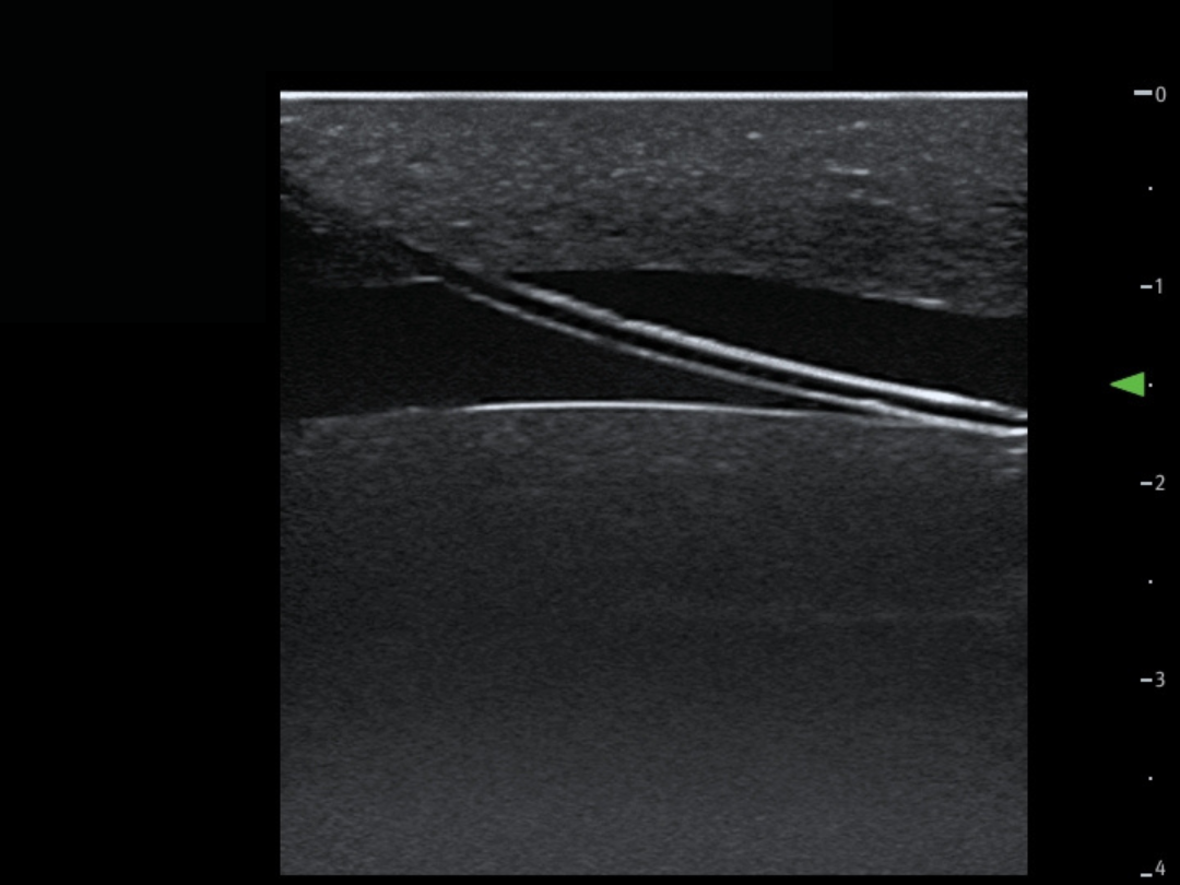 TCVC100 - TruCVC Ultrasound Imagining (1)