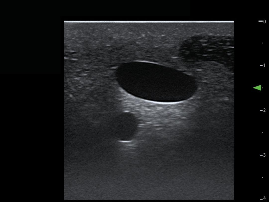 TCVC100 - TruCVC Ultrasound Imagining (3)