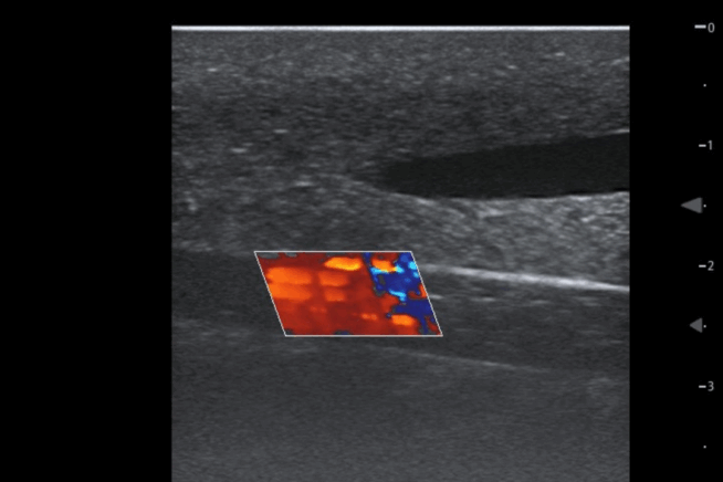 TCVC100 - TruCVC Ultrasound Imagining (7) TruCVC Ultrasound Imaging