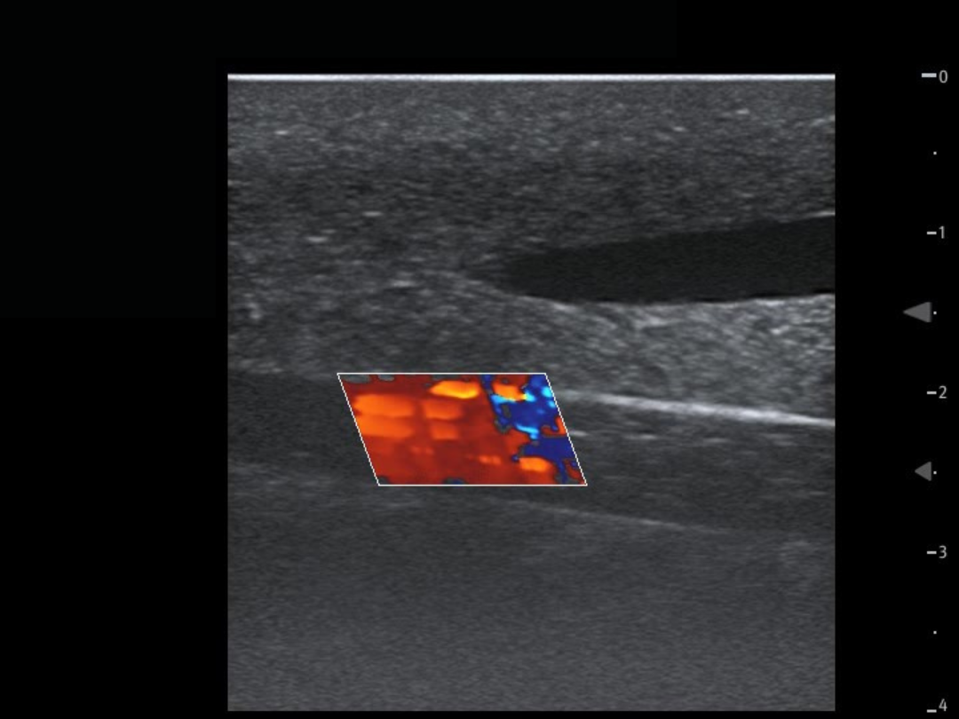 TCVC100 - TruCVC Ultrasound Imagining (7)