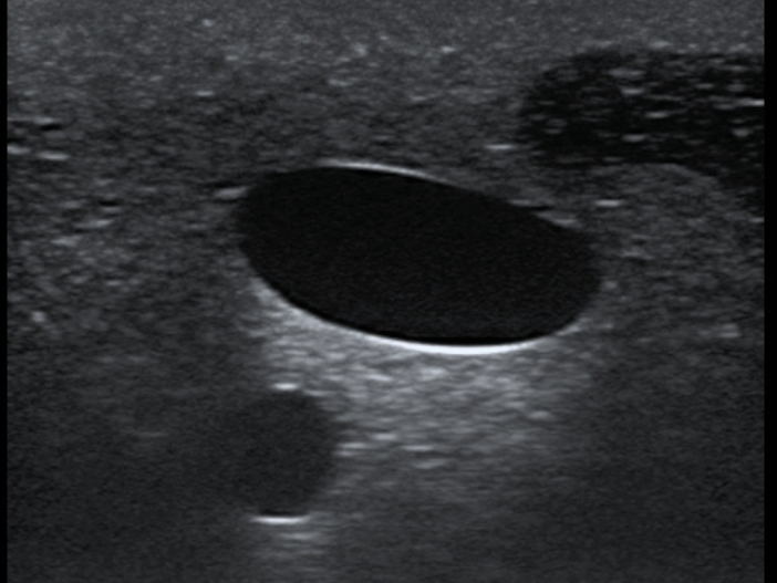 TruCVC Ultrasound Imaging