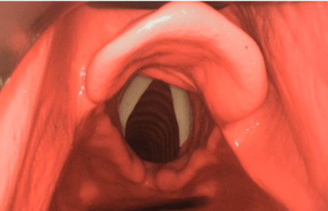 Adult Airway 2 Adult Airway 3