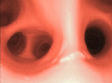 AirSim® Bronchial Tree